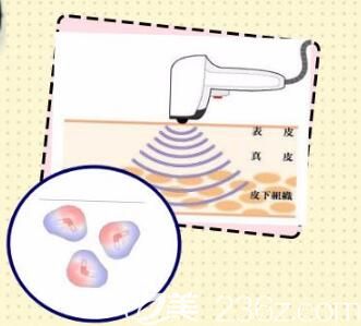射頻瘦小腿原理
