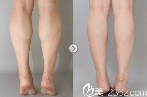 射頻瘦小腿對(duì)比案例