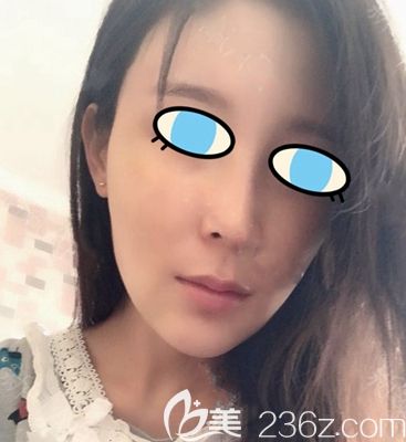 南陽維多利亞面部填充后15天 南陽維多利亞面部填充后15天