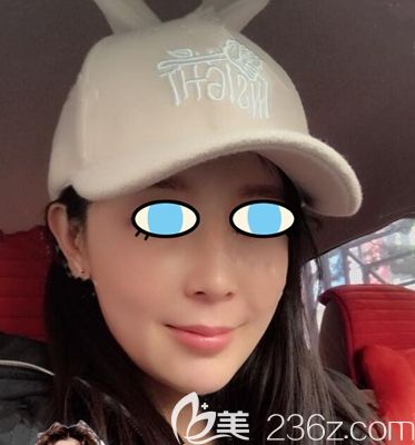 如果想去南陽做自體脂肪面部填充可以參考我這份案例對比照