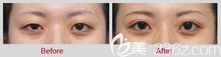 不對稱雙眼皮修復(fù)前后