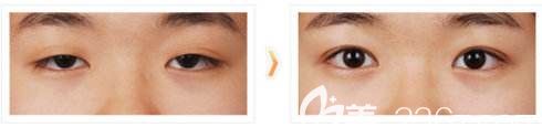雙眼皮過寬前后對比效果