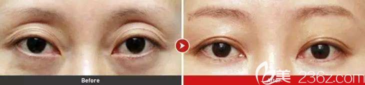 三眼皮前后對比效果