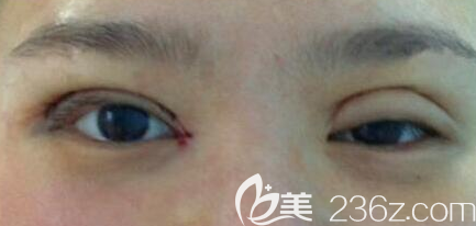 雙眼皮術(shù)后眼睛睜眼費力