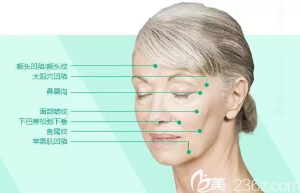 臉部凹陷填充部位示意圖