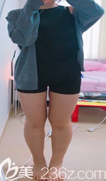 韓國365mc吸脂瘦大腿真人案例 韓國365mc吸脂瘦大腿真人案例