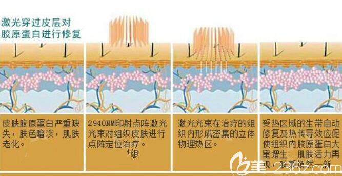 點陣激光祛痘坑原理介紹