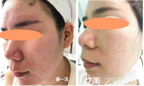 5次點陣激光祛痘坑效果圖