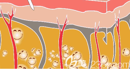 抽脂手術(shù)示意圖