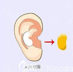 取耳軟骨示意圖