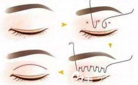 全切雙眼皮示意圖