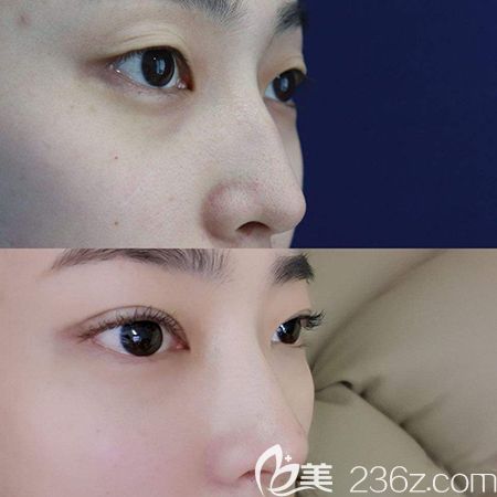 肋軟骨隆鼻術(shù)后效果對比