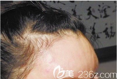 面部自體脂肪填充過(guò)量