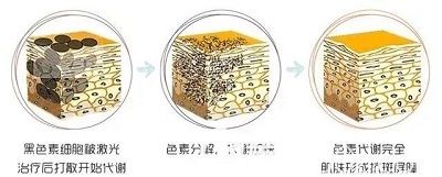 超皮秒祛斑手術(shù)原理