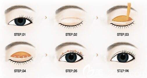 全切雙眼皮示意圖