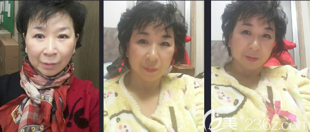 顴脂墊下移顯老韓國JJ洪鎮(zhèn)柱面中部提升術雙眼皮讓老阿姨重回18歲