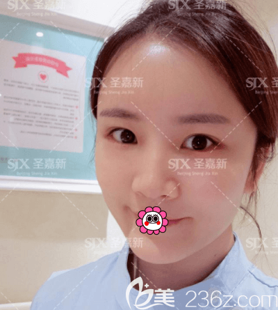 北京圣嘉新自體脂肪填充全臉案例 北京圣嘉新自體脂肪填充全臉案例