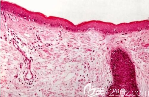 從病理切片圖看黃褐斑在皮膚內(nèi)存在的情況