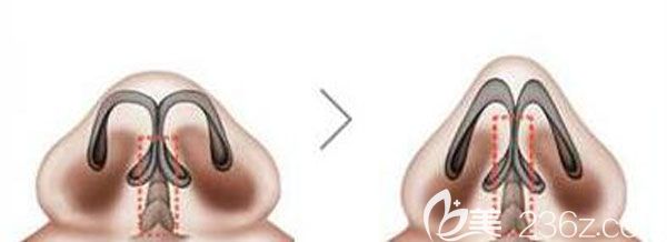 假體鼻小柱延長的切口在哪