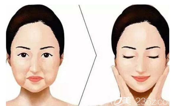 為什么線雕后面部會(huì)出現(xiàn)凹陷