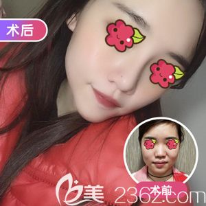 汪福強(qiáng)院長(zhǎng)做韓式生科假體隆鼻術(shù)前術(shù)后對(duì)比 汪福強(qiáng)院長(zhǎng)做韓式生科假體隆鼻術(shù)前術(shù)后對(duì)比