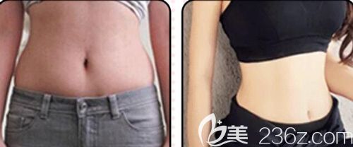 汪洋醫(yī)生做腰腹吸脂術(shù)后30天腰部明顯變細(xì) 汪洋醫(yī)生做腰腹吸脂術(shù)后30天腰部明顯變細(xì)