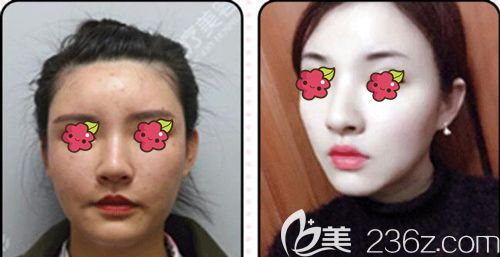 項(xiàng)利姣院長(zhǎng)做自體脂肪面部填充術(shù)后面部輪廓線變明顯 項(xiàng)利姣院長(zhǎng)做自體脂肪面部填充術(shù)后面部輪廓線變明顯