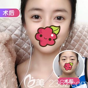 做無(wú)痕精雕雙眼皮選擇項(xiàng)利姣醫(yī)生 做無(wú)痕精雕雙眼皮選擇項(xiàng)利姣醫(yī)生