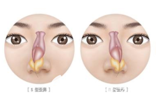 S型歪鼻等示意圖 S型歪鼻等示意圖