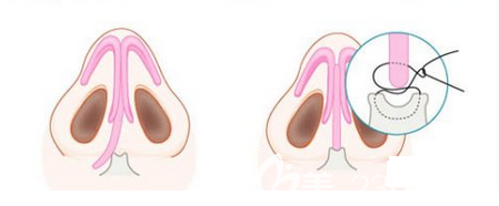 歪鼻手術示意圖 歪鼻手術示意圖