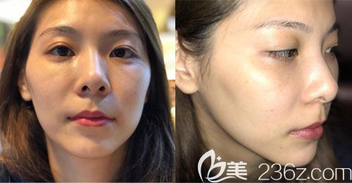 韓國那木整形醫(yī)院顴骨顴弓整形案例 韓國那木整形醫(yī)院顴骨顴弓整形案例