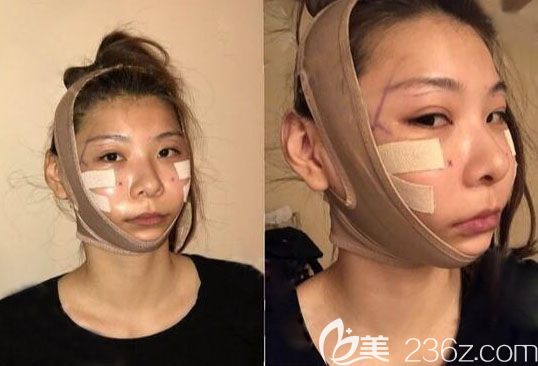 韓國顴骨顴弓整形術(shù)后3天恢復(fù)效果圖 韓國顴骨顴弓整形術(shù)后3天恢復(fù)效果圖