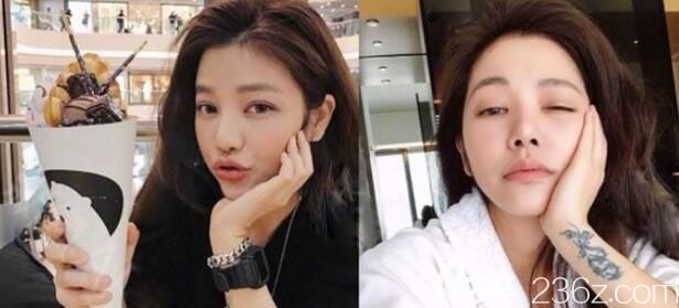 顴骨內(nèi)推術(shù)后1個月真實(shí)恢復(fù)效果圖 顴骨內(nèi)推術(shù)后1個月真實(shí)恢復(fù)效果圖