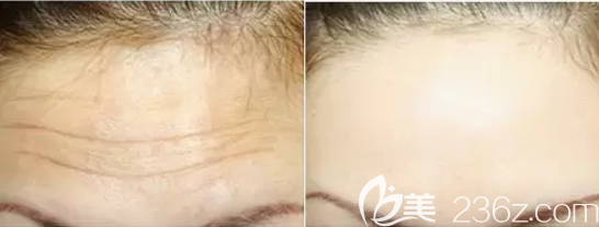 抬頭紋去除效果對(duì)比