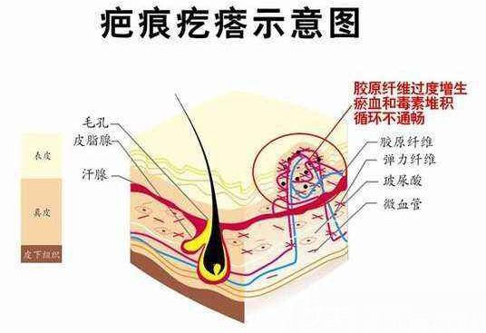 疤痕增生的形成示意圖
