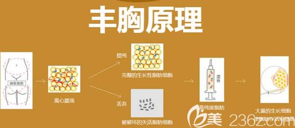 自體脂肪豐胸原理