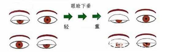 眼瞼下垂會(huì)造成什么影響？