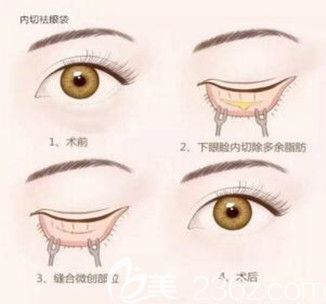 內(nèi)路祛眼袋過程示意圖