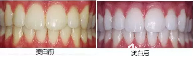 牙齒冷光美白后效果對(duì)比