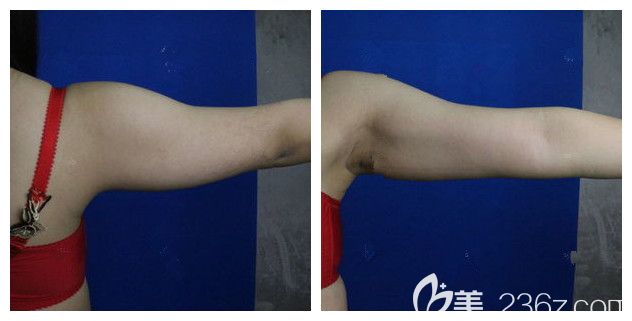 面診南京韓辰術(shù)前粗壯的胳膊 面診南京韓辰術(shù)前粗壯的胳膊