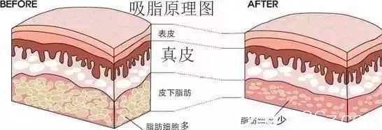 吸脂瘦手臂原理 吸脂瘦手臂原理
