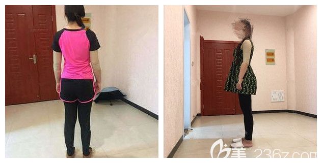 術(shù)后一個(gè)月穿著塑身衣的手臂 術(shù)后一個(gè)月穿著塑身衣的手臂