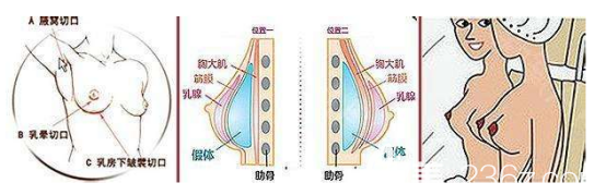 假體隆胸的手術(shù)切口和假體放置的位置