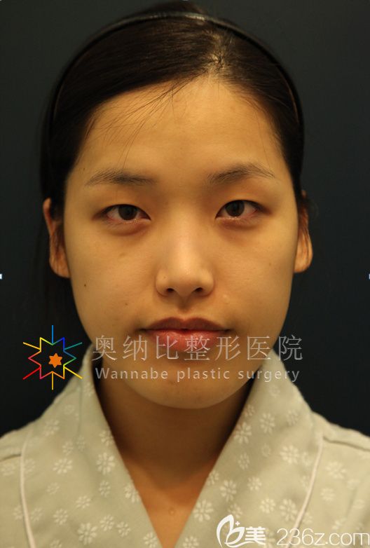 韓國奧納比張哲豪做雙眼皮怎么樣 韓國奧納比張哲豪做雙眼皮怎么樣