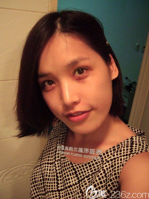 韓國奧納比雙眼皮真人案例 韓國奧納比雙眼皮真人案例