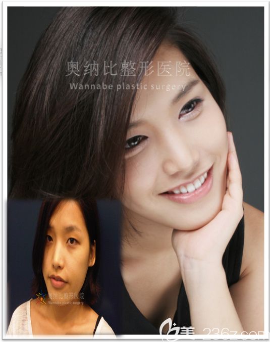 韓國奧納比雙眼皮真人案例 韓國奧納比雙眼皮真人案例