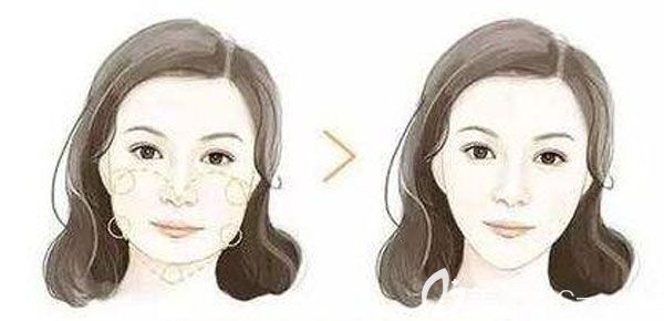 玻尿酸面部填充多久可以恢復