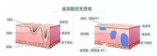 玻尿酸填充原理