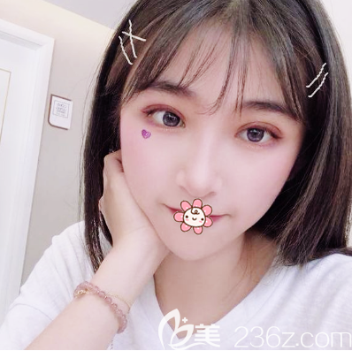 看朋友找佛山華美梁宗建院長(zhǎng)做的雙眼皮效果那么自然我也忍不住去做了眼綜合