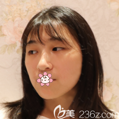 在佛山華美做雙眼皮術前照片 在佛山華美做雙眼皮術前照片